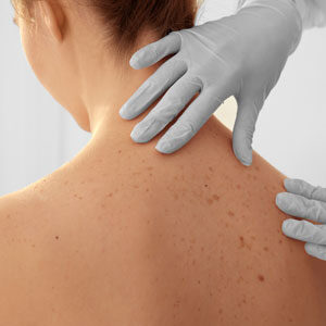 Woman's skin being examined by a doctor